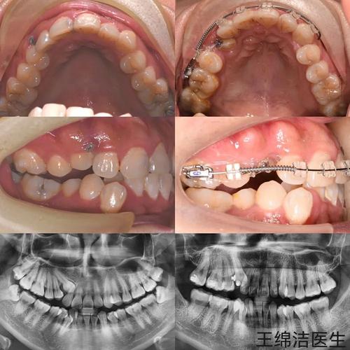 成人正畸选华西口腔效果如何？适合哪些牙齿问题？费用和周期怎么样？-图1