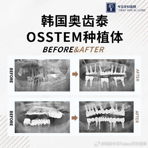 种牙日韩奥齿泰-图3