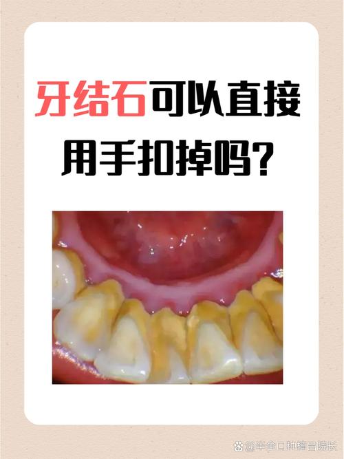 清除牙石方法-图3