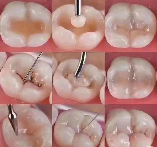 杭州补牙方法有哪些?哪种材质更适合自己?-图2 杭州补牙方法有哪些?哪种材质更适合自己?-图2