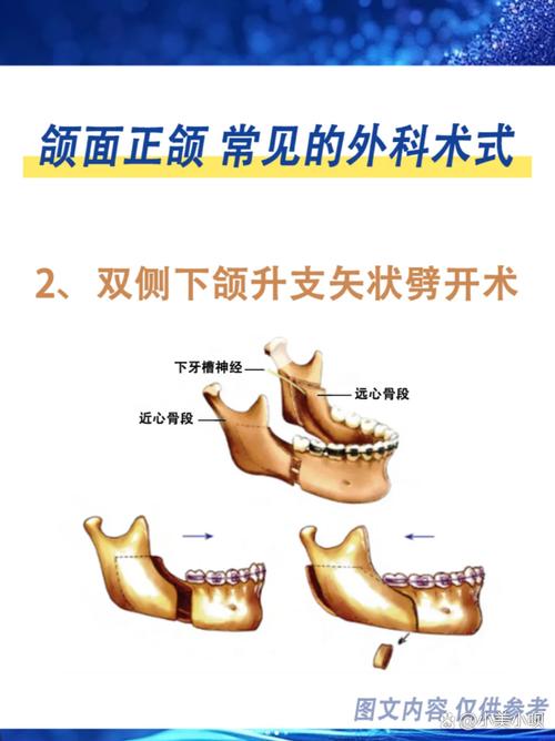 正颌手术方法-图1