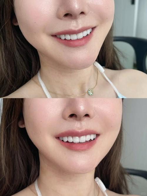 牙齿贴面方法怎么选?哪种更适合自己?-图3 牙齿贴面方法怎么选?哪种更适合自己?-图3