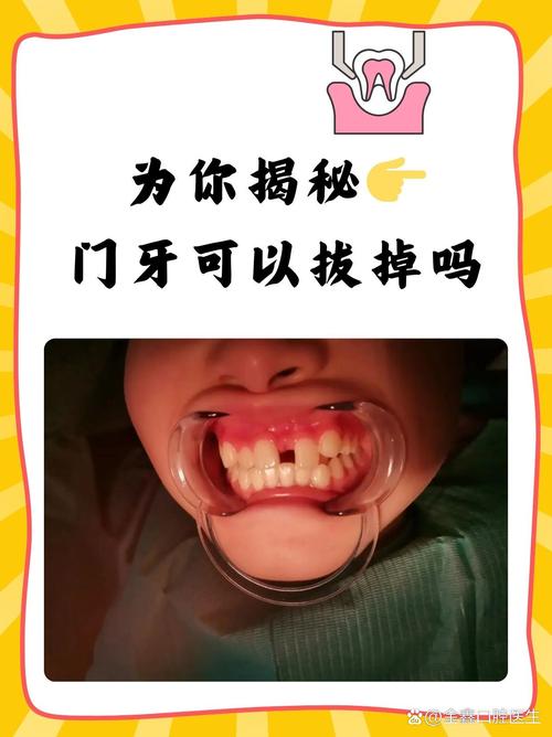 正畸可以只拔一颗牙吗-图2