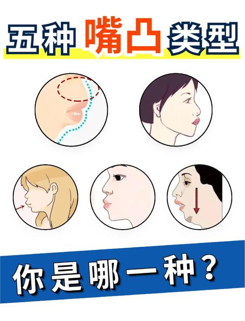 不拔牙正畸嘴为什么凸-图2