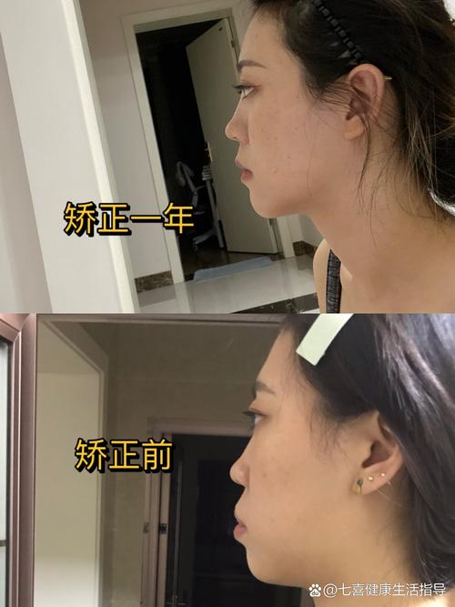 不拔牙正畸嘴为什么凸-图3