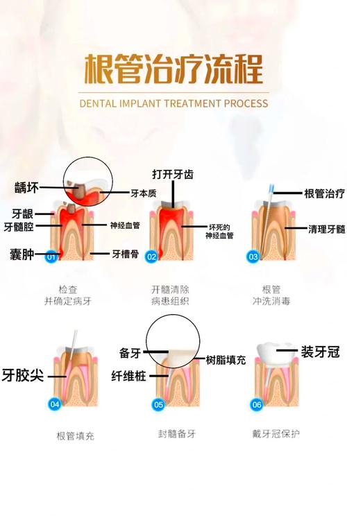 牙管治疗方法-图1 牙管治疗方法-图1