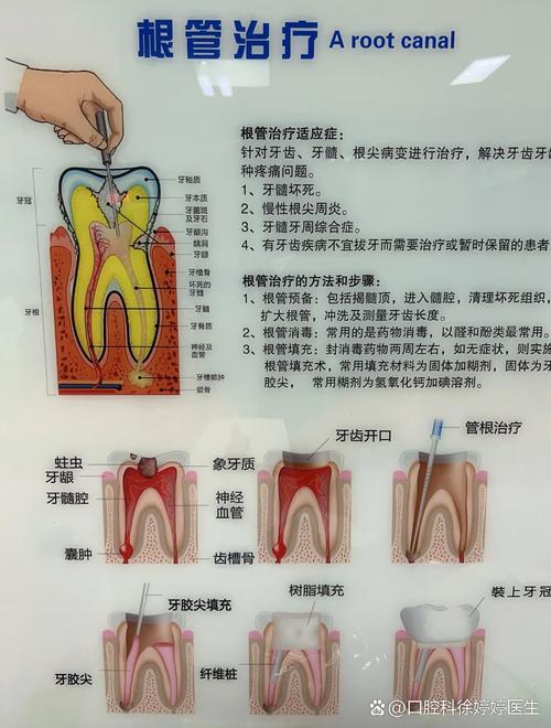 牙管治疗方法-图2 牙管治疗方法-图2