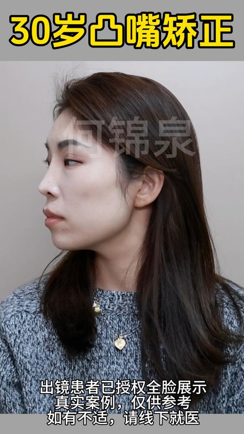 30岁正畸效果怎么样-图2