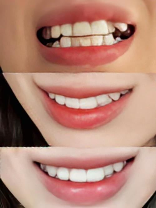 30岁正畸效果怎么样-图1