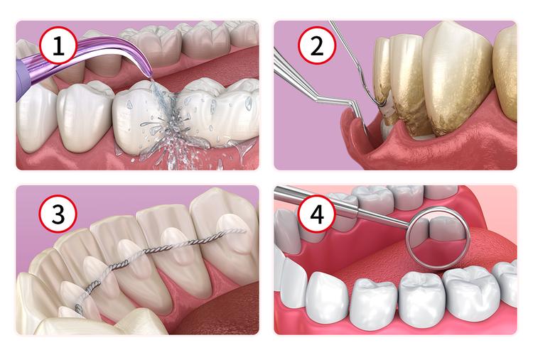 牙周治疗方法-图3