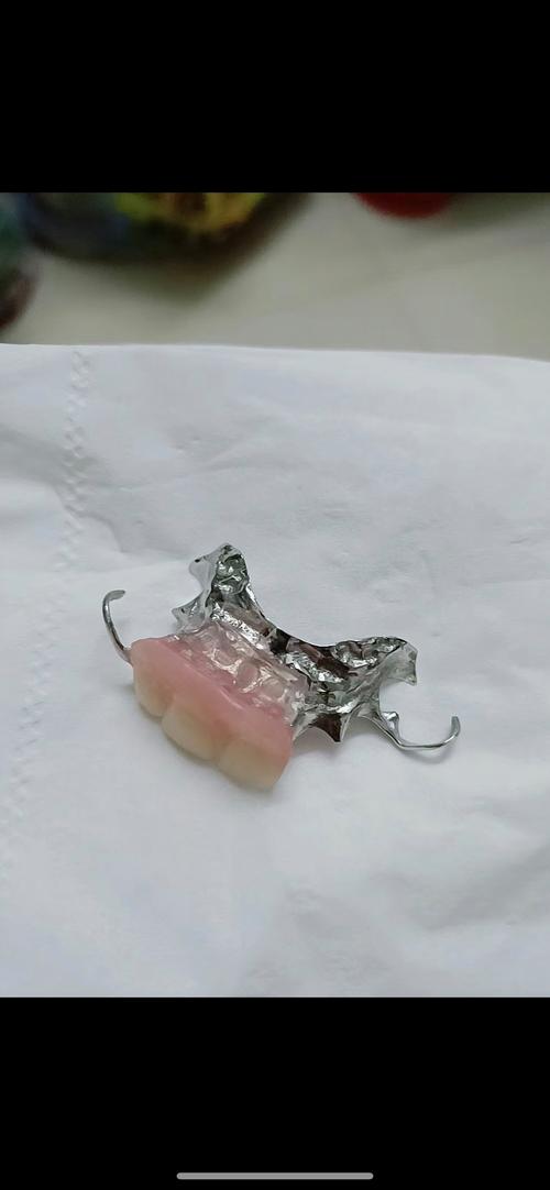 种牙叫固定义齿-图2