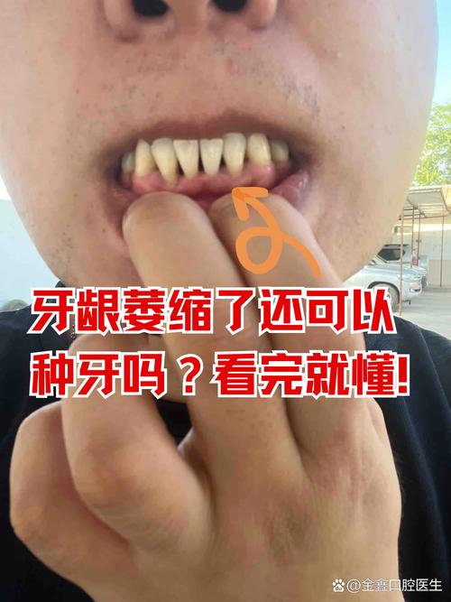 没牙龈能种牙吗-图1