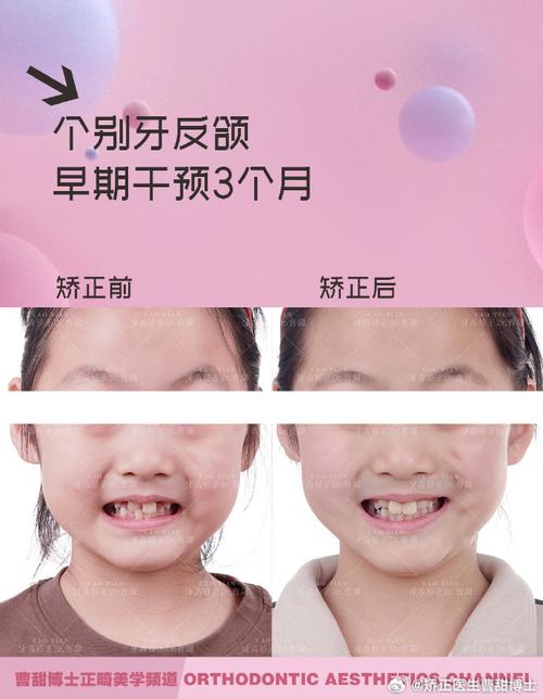 小孩正畸牙齿的最佳矫正年龄是什么时候?-图2 小孩正畸牙齿的最佳矫正年龄是什么时候?-图2