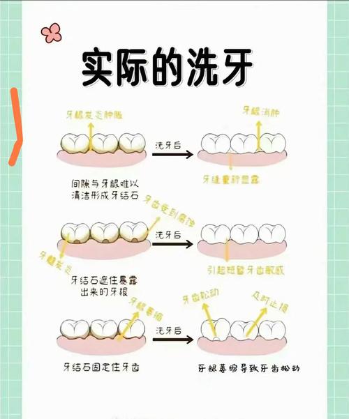 快速洁牙方法-图3 快速洁牙方法-图3
