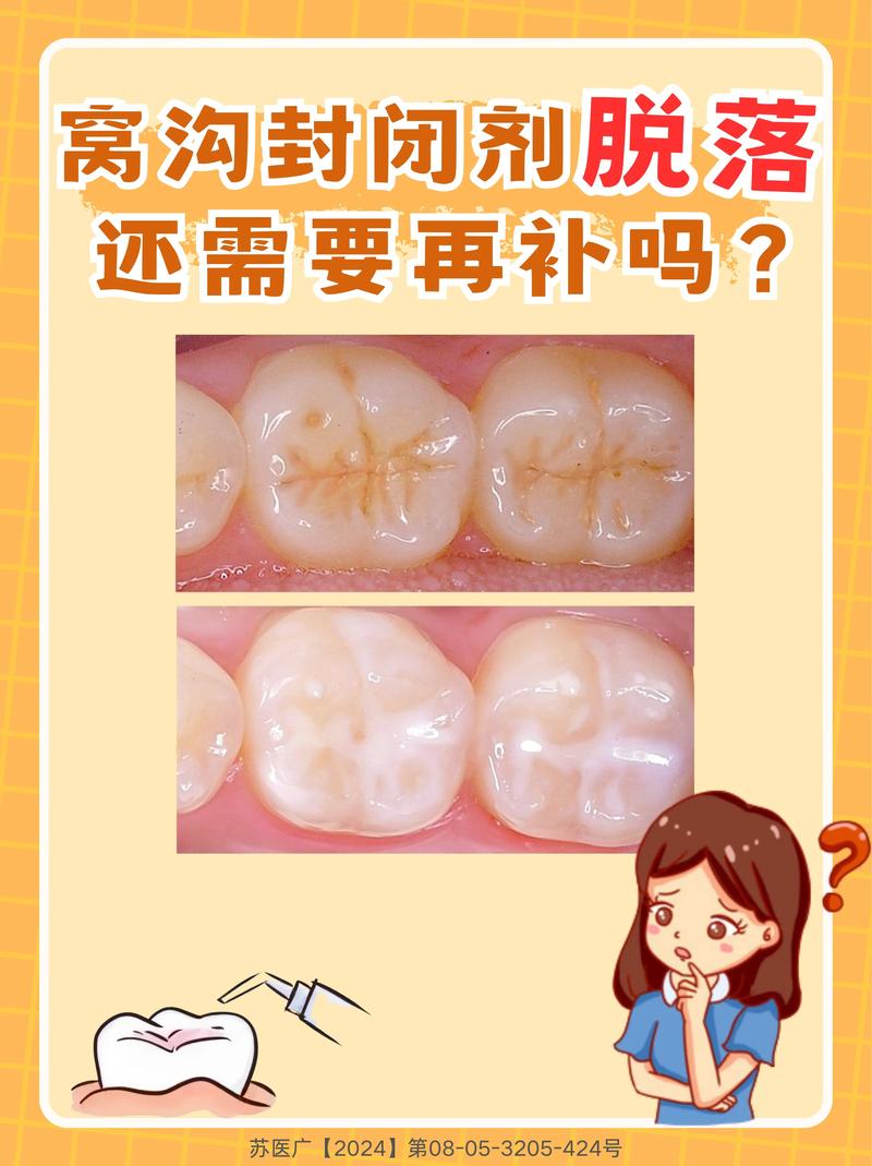 蛀牙修复方法-图3