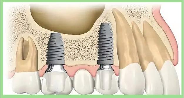 数字化导航种牙，精准高效有何优势？-图1