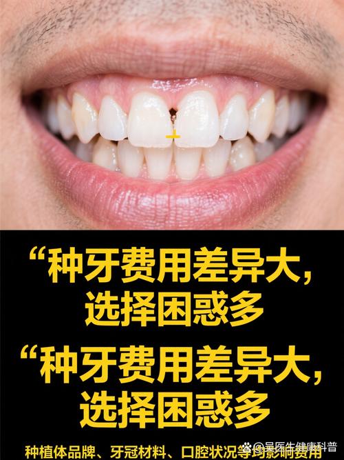 去韩国种牙贵吗-图3