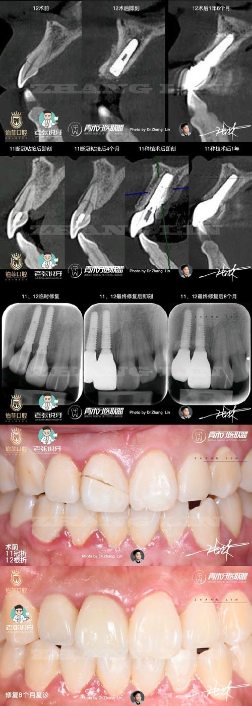核冠修复和种牙-图2 核冠修复和种牙-图2