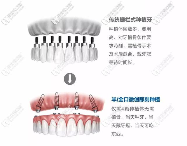 什么地方能种牙-图3 什么地方能种牙-图3