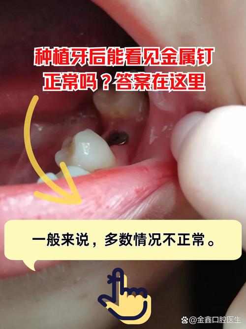 种牙钉周围肿疼是什么原因？该怎么处理？-图1