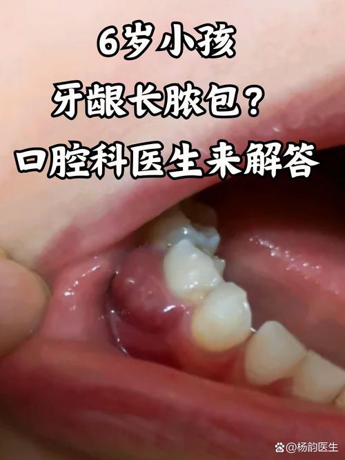 种牙钉周围肿疼是什么原因？该怎么处理？-图2