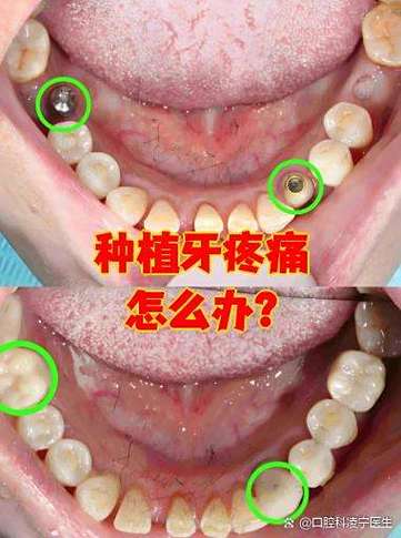 种牙后疼痛一般会持续多久？-图3