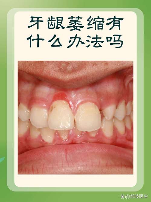 正畸会导致牙龈萎缩吗-图1 正畸会导致牙龈萎缩吗-图1