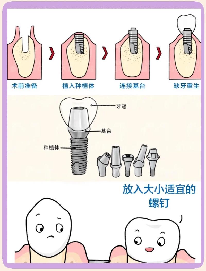种植牙随种随用-图2