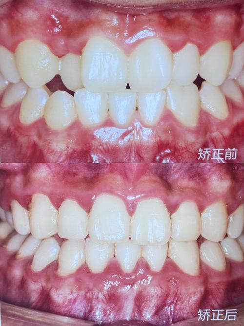 牙齿正畸前后对比图片，究竟藏着哪些肉眼可见的惊人变化？-图2