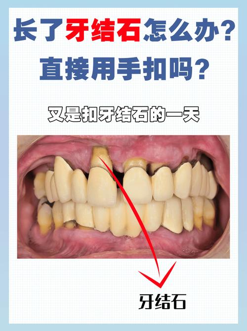 去牙石的方法-图3