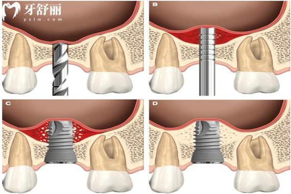种牙上颌窦提拉是什么？技术原理、效果及安全风险如何？-图2