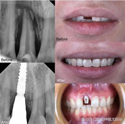 上颌没牙种8颗是常规方案吗?这样种植效果有保障吗?-图1 上颌没牙种8颗是常规方案吗?这样种植效果有保障吗?-图1