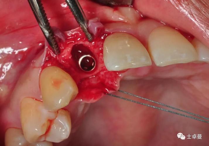 上颌没牙种8颗是常规方案吗?这样种植效果有保障吗?-图3 上颌没牙种8颗是常规方案吗?这样种植效果有保障吗?-图3
