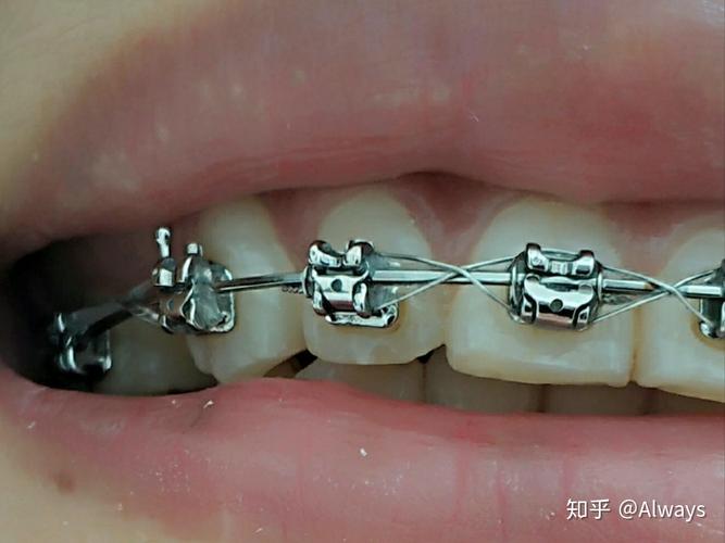 正畸锁丝是干什么的？揭秘它在牙齿矫正中的关键作用-图3