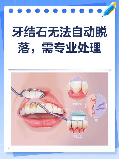 如何有效去除牙石？不同方法的效果和安全性如何？-图3