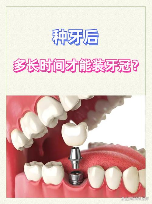 种牙后一般多久会脱落?使用寿命有多久?-图2 种牙后一般多久会脱落?使用寿命有多久?-图2