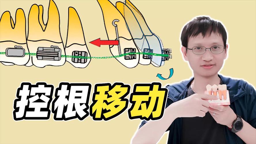 正畸控根是干什么的-图2