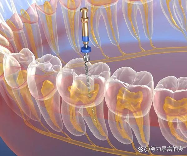 正畸控根是干什么的-图3