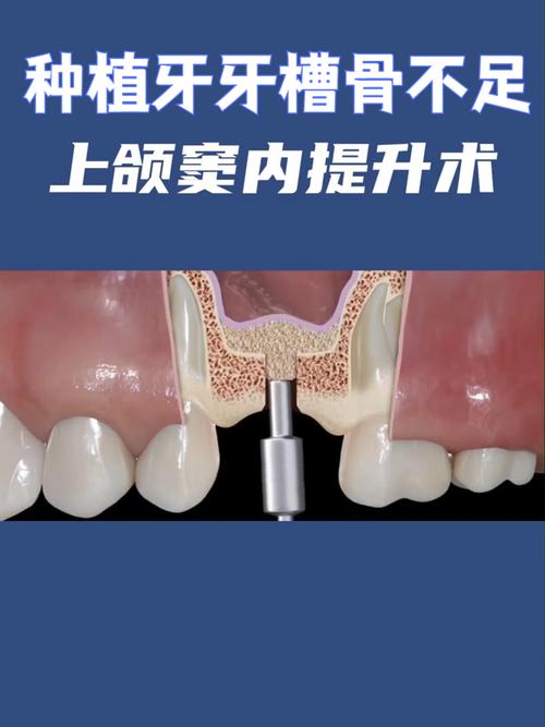 种牙离上额窦近，会有风险吗？需注意什么？-图2