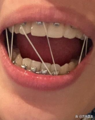 拔虎牙能种牙吗-图1 拔虎牙能种牙吗-图1
