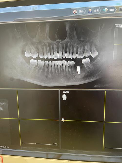 种牙后取模到底要等多久？最佳时间是什么时候？-图3
