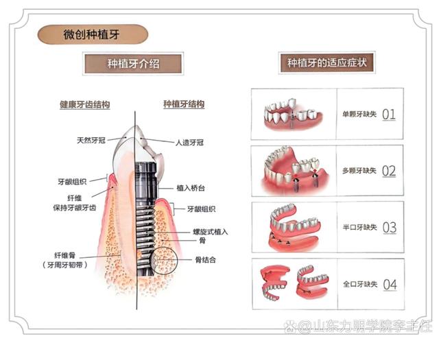 劈冠的正确方法是什么?具体步骤和技巧有哪些?-图1 劈冠的正确方法是什么?具体步骤和技巧有哪些?-图1