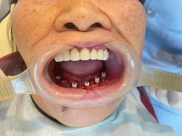 老年人镶牙种牙怎么选？晚年生活哪种更实用？-图1