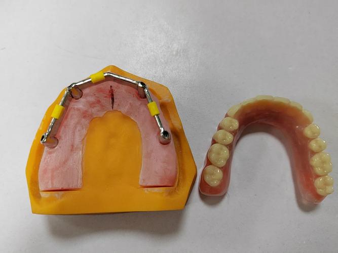 老年人镶牙种牙怎么选？晚年生活哪种更实用？-图2