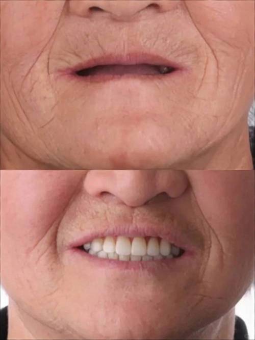 老人不适合种牙?其实这些情况也能种,关键看这几点?-图3 老人不适合种牙?其实这些情况也能种,关键看这几点?-图3