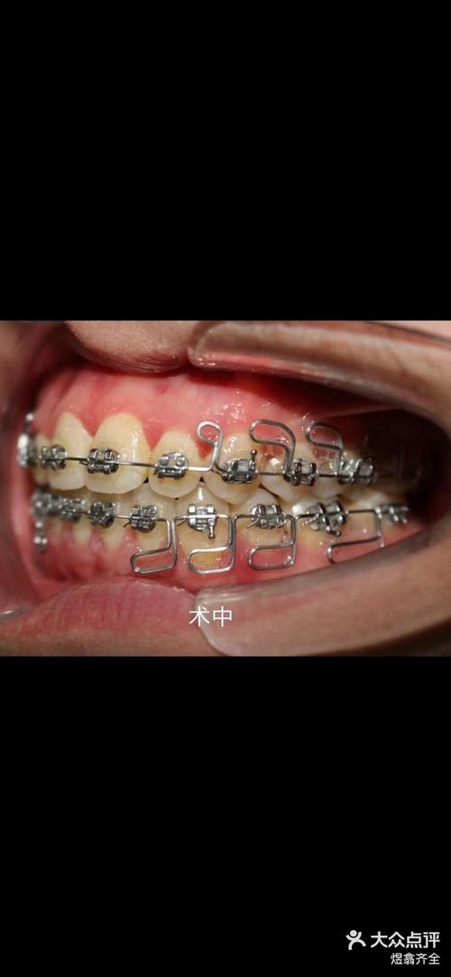 正畸最后一根弓丝，矫正效果能稳如预期吗？-图3