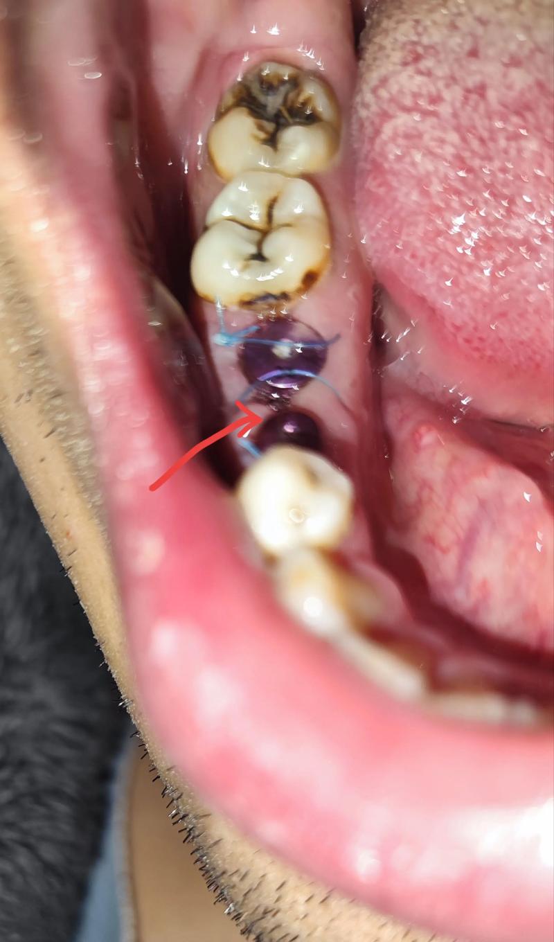 种牙以后会疼吗-图3