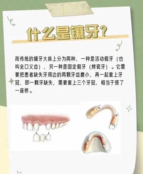 镶牙齿方法-图1