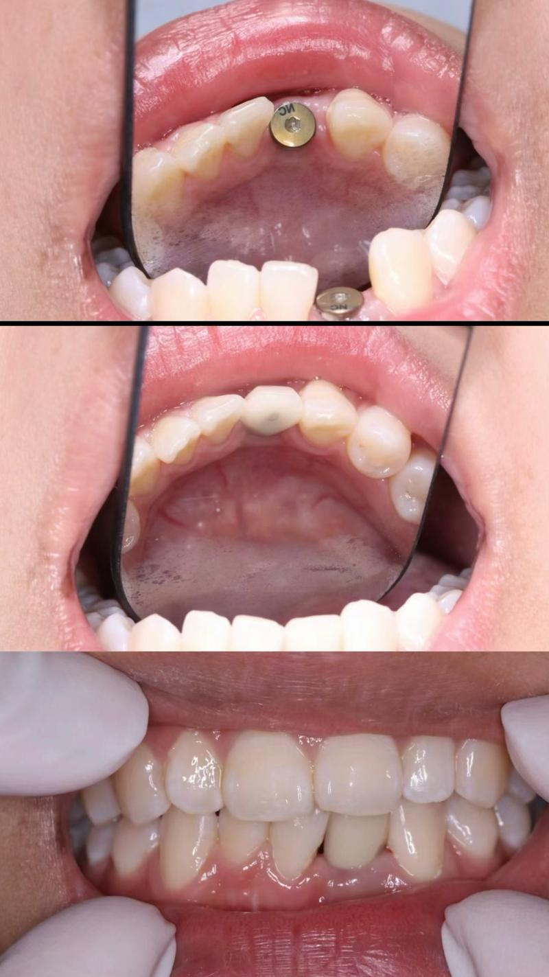 即拔即种牙实例，当天种牙真的可行吗？效果与风险如何评估？-图2