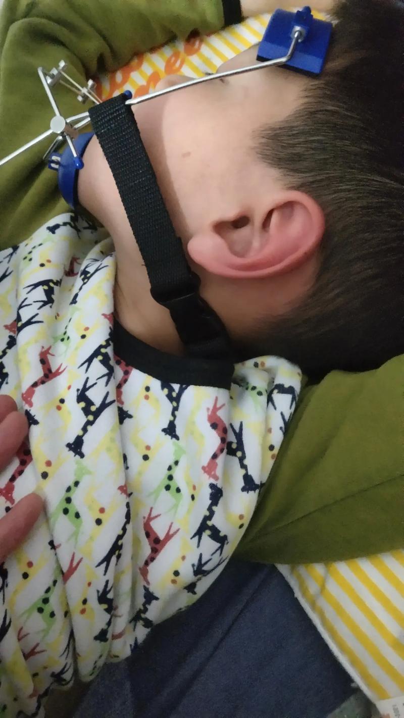 地包天正畸的具体作用有哪些?-图3 地包天正畸的具体作用有哪些?-图3